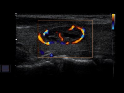 Щитовидная железа, узел, двунаправленный энергетический допплер / РуСкан 50