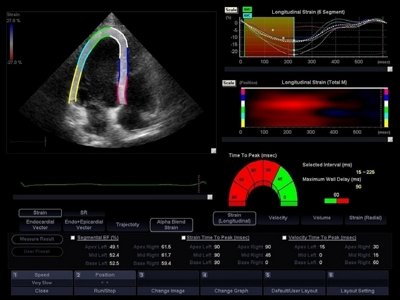 Сердце, недоплеровская оценка глобальной и сегментарной сократимости ЛЖ / РуСкан 50
