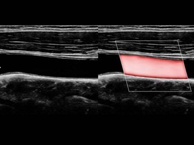 Общая сонная артерия, S-Flow™ / РуСкан 65