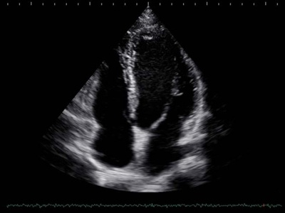 Сердце, 4-х камерная проекция / РуСкан 65М