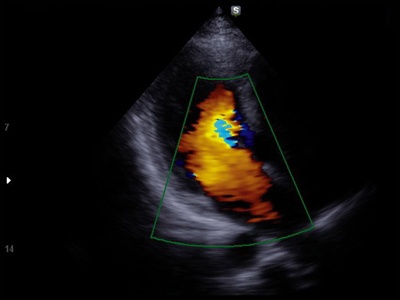 Сердце, цветной допплер / РуСкан 70П