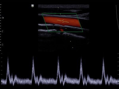 Общая сонная артерия, триплексный режим / РуСкан 70П
